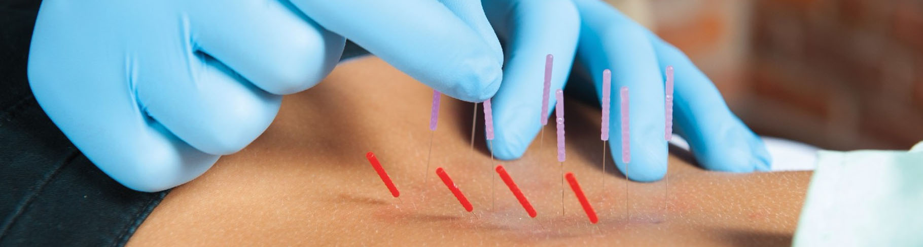 Dry Needling